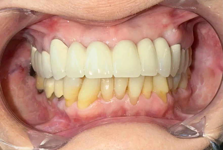 After photo of the same patient's smile